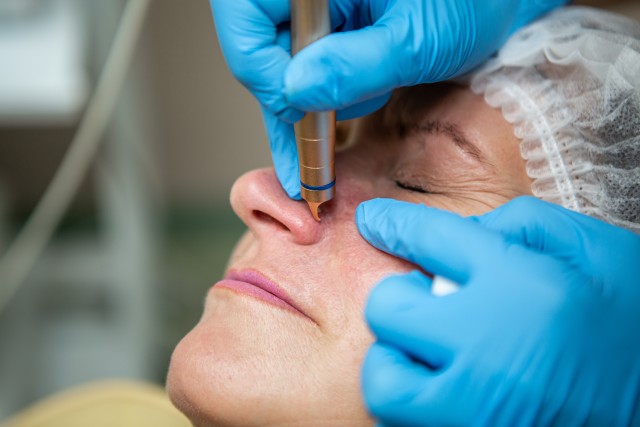 rosacea-tretirane rosacea-tretirane